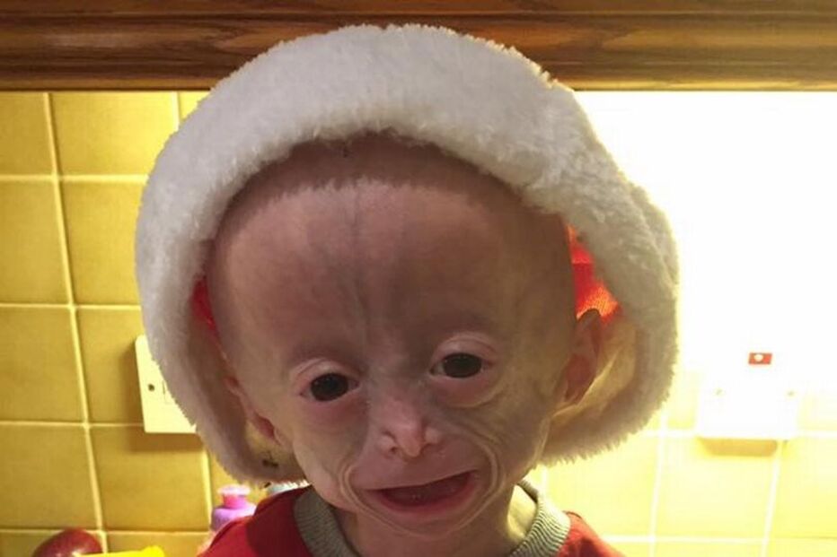 Morreu Lucy, a menina com doença rara que a fazia envelhecer oito vezes mais rápido