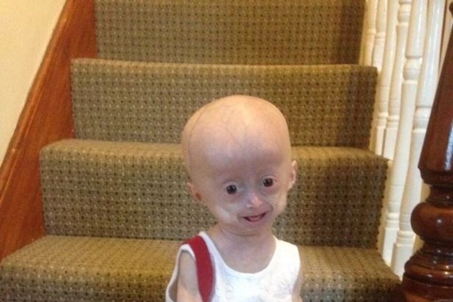 Morreu Lucy, a menina com doença rara que a fazia envelhecer oito vezes mais rápido