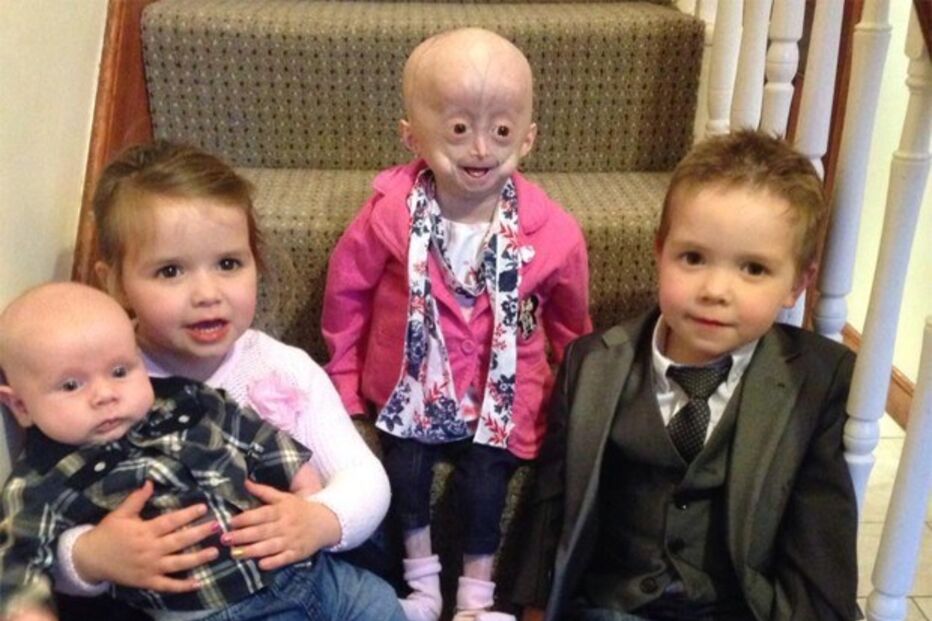 Morreu Lucy, a menina com doença rara que a fazia envelhecer oito vezes mais rápido