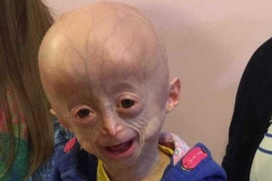 Morreu Lucy, a menina com doença rara que a fazia envelhecer oito vezes mais rápido