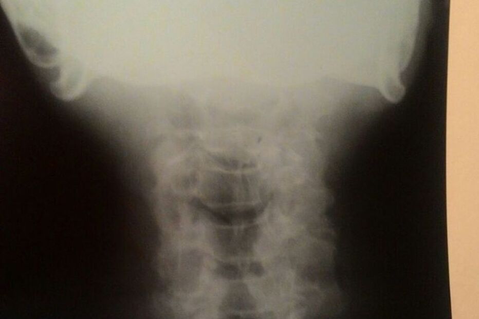Homem ficou com prótese dentária entalada na garganta durante 40 horas