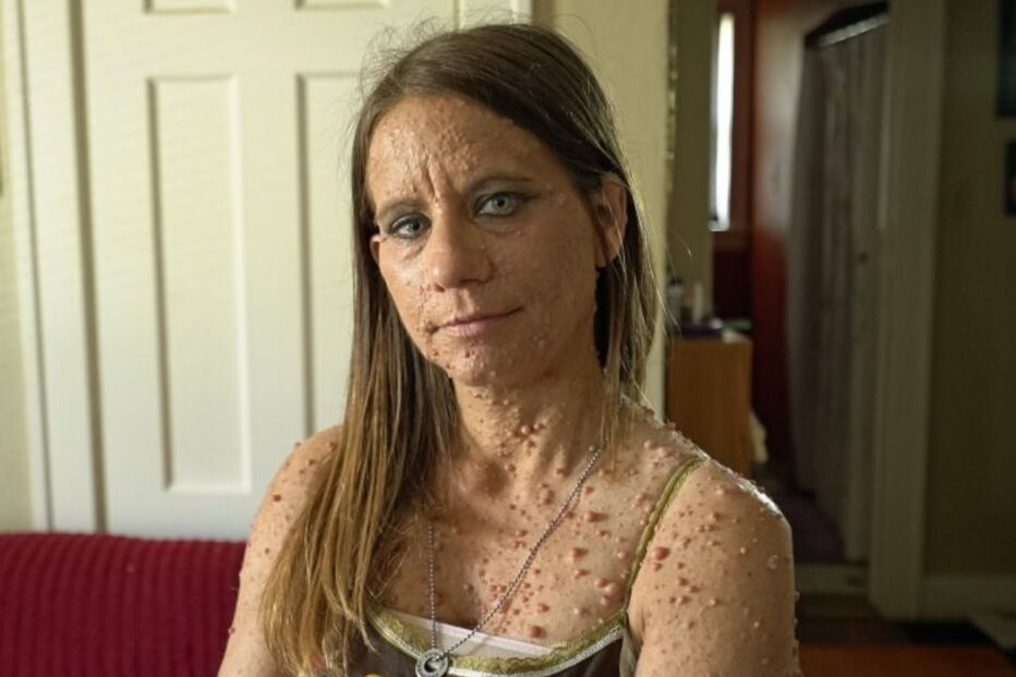 Libby Huffer, doença, tumor, EUA