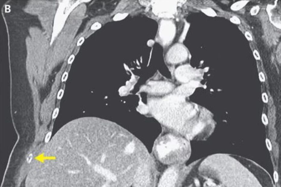 Mulher parte as costelas ao tossir compulsivamente