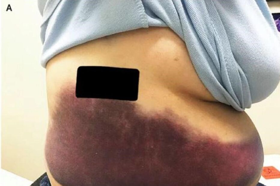 Mulher parte as costelas ao tossir compulsivamente