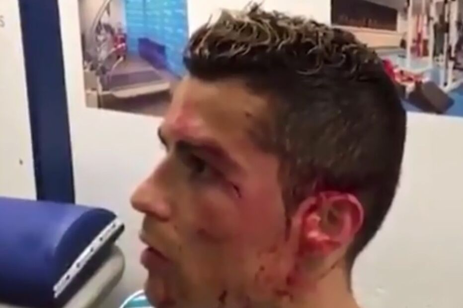 Cristiano Ronaldo lesionado