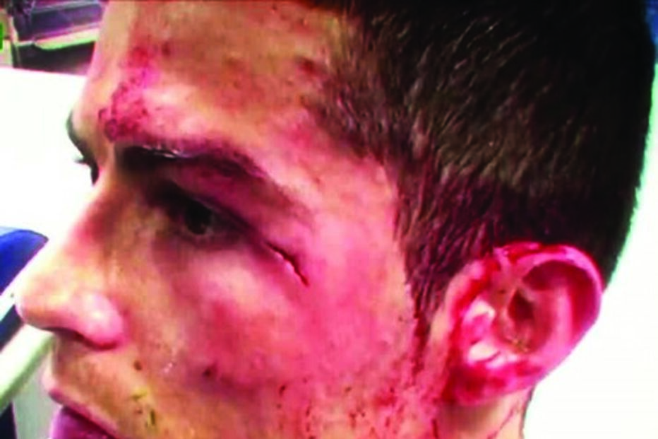 O golpe de Ronaldo junto ao olho   