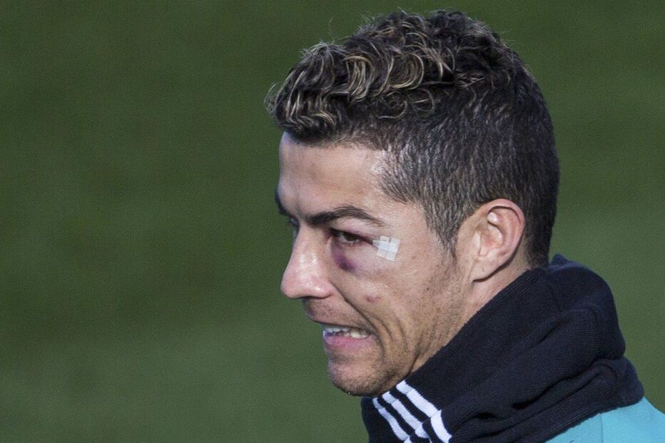 Cristiano Ronaldo regressou aos treinos do Real Madrid com o olho negro e inchado 