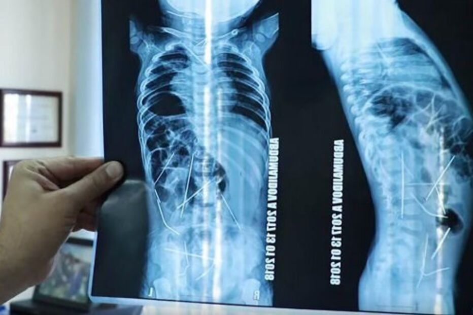 Bebé de 11 meses tinha 16 agulhas dentro do corpo