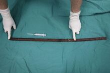 Homem ferido com barra de aço enfiada no ânus