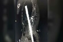 Homem ferido com barra de aço enfiada no ânus