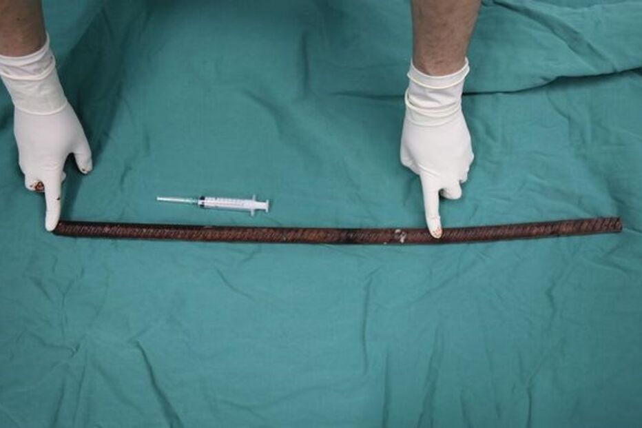 Homem ferido com barra de aço enfiada no ânus