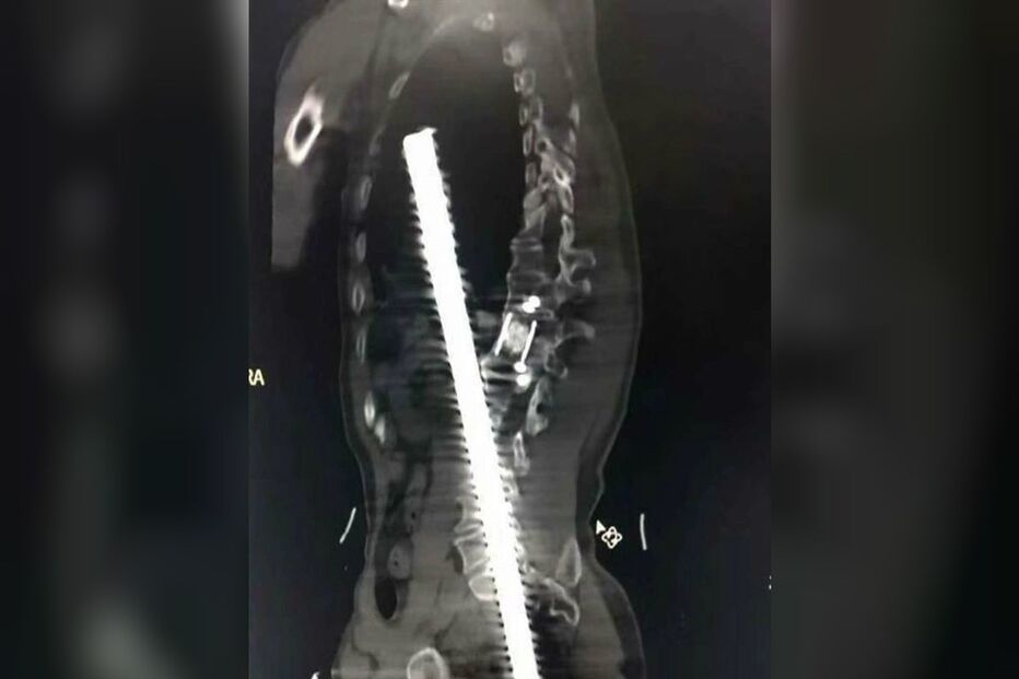 Homem ferido com barra de aço enfiada no ânus