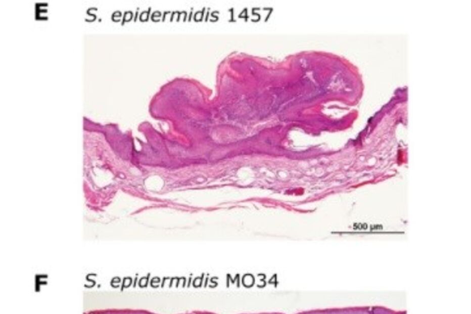 Staphylococcus epidermidis