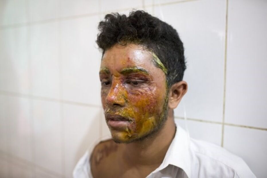 Menina de 16 anos ataca jovem com ácido por ele não querer namorar