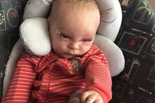 Bebé com condição rara que deixa pele em escamas curado com óleo de canábis