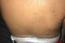 Bebé com condição rara que deixa pele em escamas curado com óleo de canábis