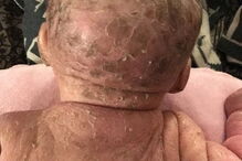 Bebé com condição rara que deixa pele em escamas curado com óleo de canábis