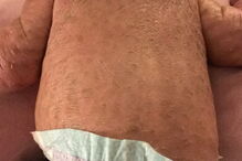 Bebé com condição rara que deixa pele em escamas curado com óleo de canábis