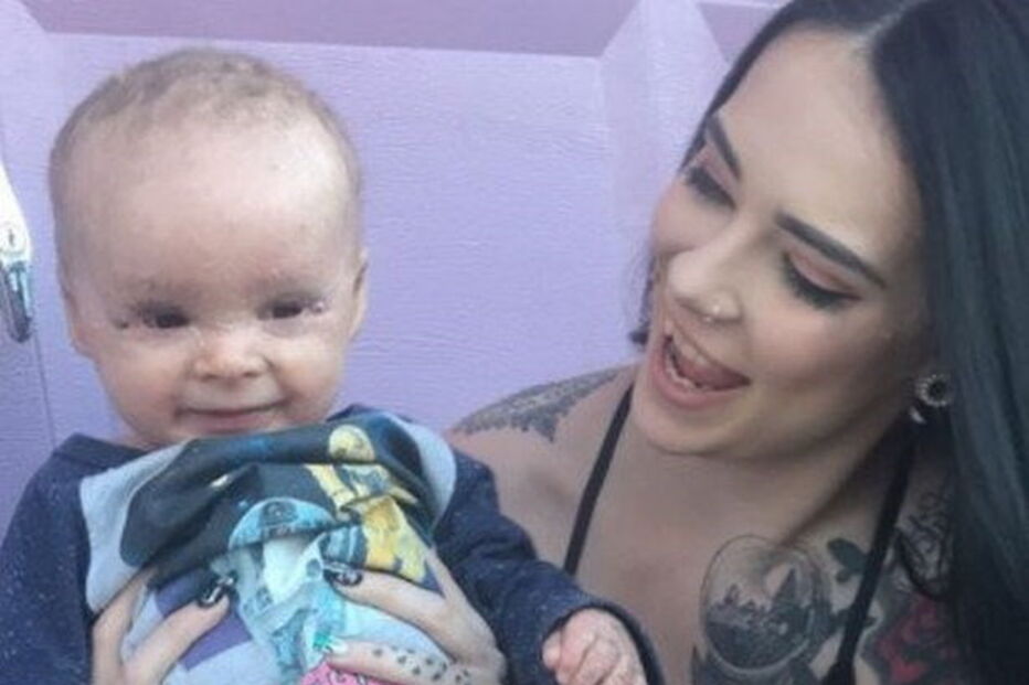 Bebé com condição rara que deixa pele em escamas curado com óleo de canábis