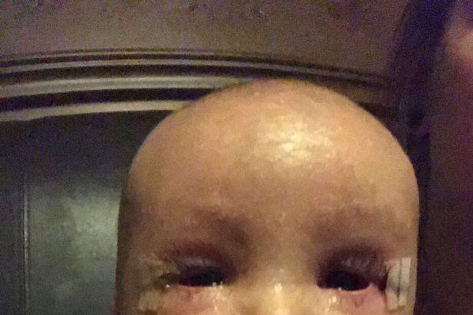 Bebé com condição rara que deixa pele em escamas curado com óleo de canábis