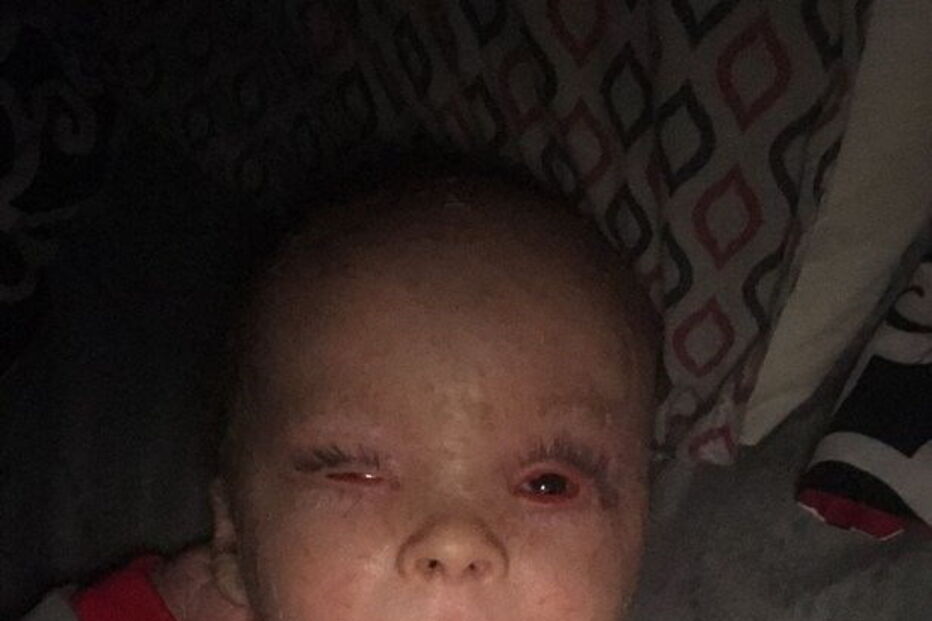 Bebé com condição rara que deixa pele em escamas curado com óleo de canábis