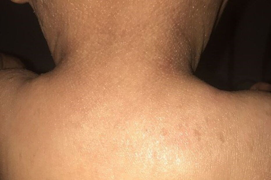 Bebé com condição rara que deixa pele em escamas curado com óleo de canábis