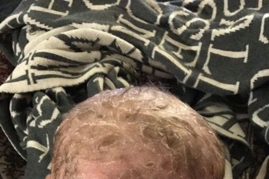 Bebé com condição rara que deixa pele em escamas curado com óleo de canábis