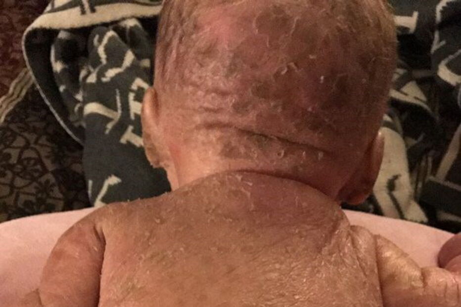 Bebé com condição rara que deixa pele em escamas curado com óleo de canábis