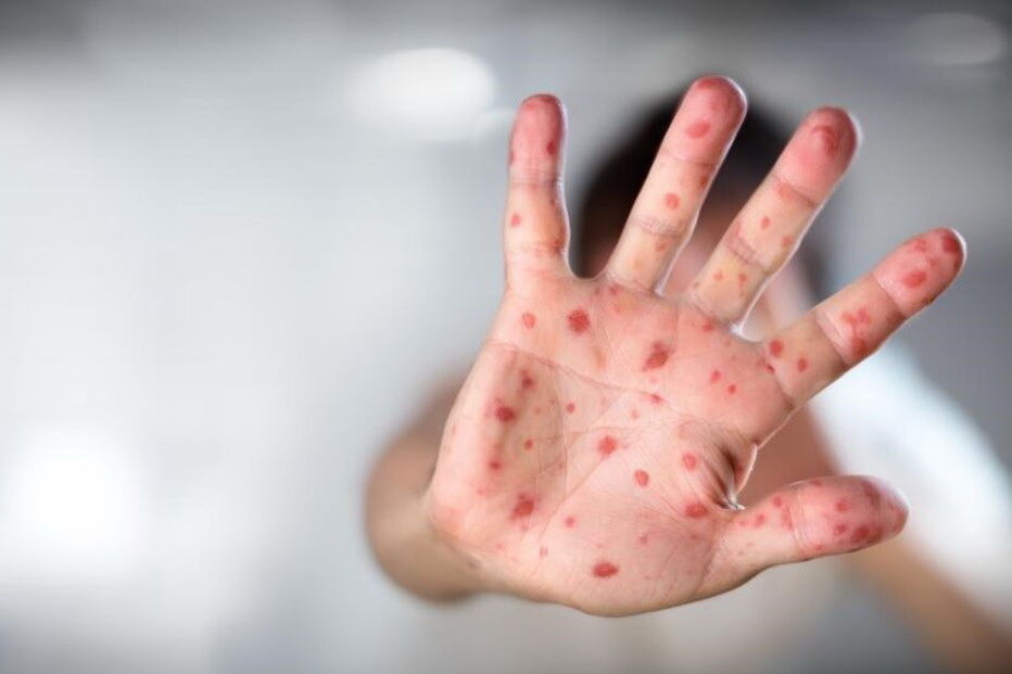 Todos os 109 casos confirmados de sarampo no surto da região Norte estão curados, havendo ainda 18 casos a ser investigados, segundo um boletim esta sexta-feira emitido pela Direção-geral da Saúde (DGS)