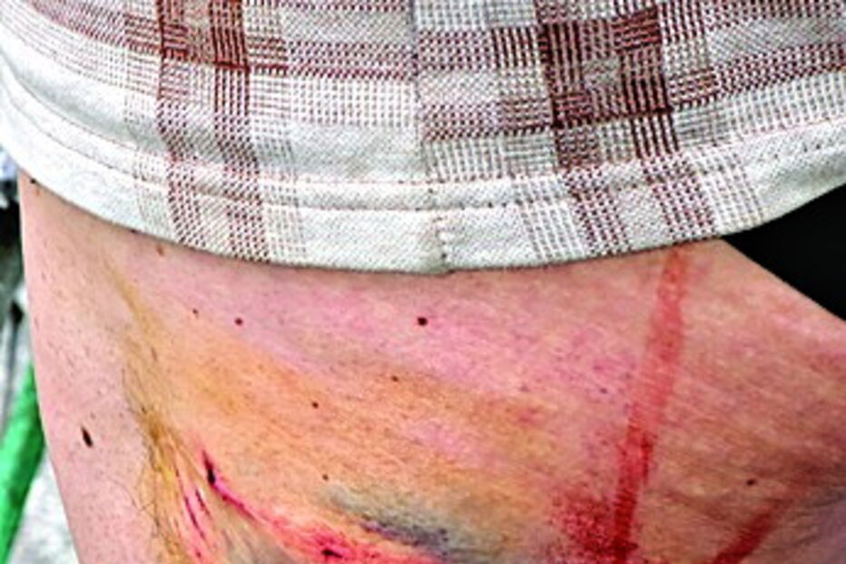 Cão mordeu mulher na perna