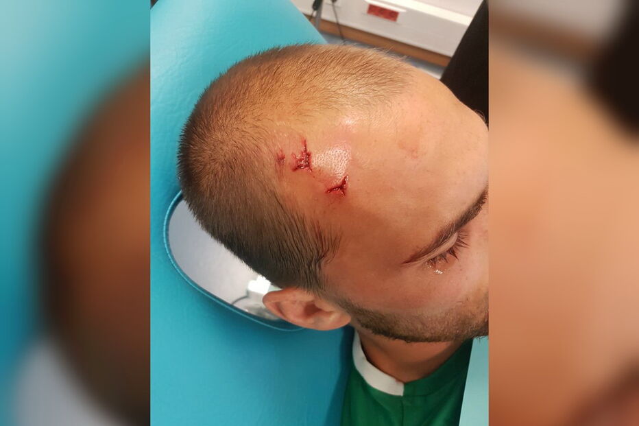 Bas Dost abriu a cabeça em dois sitíos e foi suturado