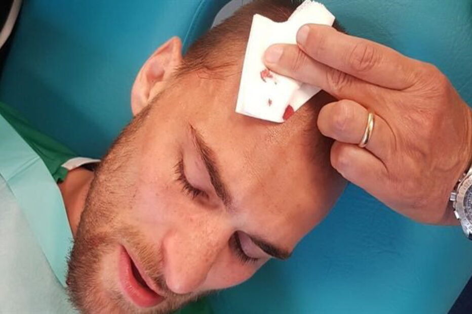 Bas Dost abriu a cabeça em dois sitíos e foi suturado