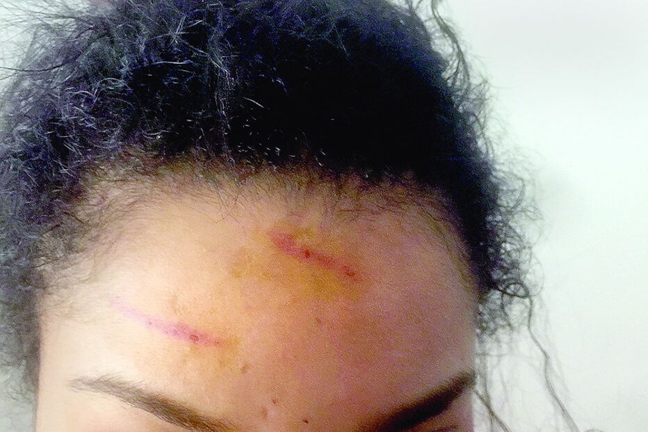 Marcas de agressões