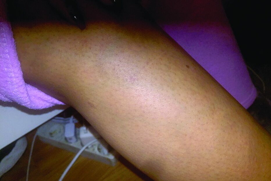 Marcas de agressões