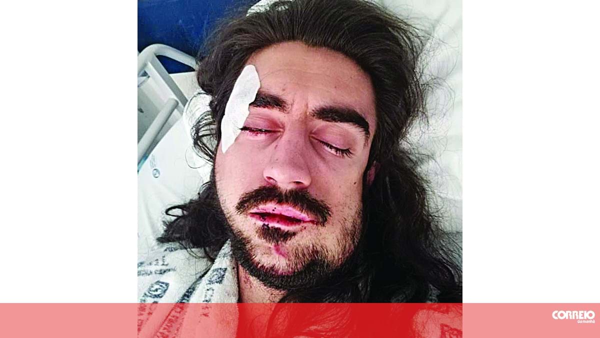 Ator espancado em Lisboa fica sem dentes - Portugal ...