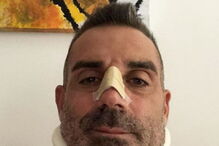 Stefano Sorrentino parte o nariz ao chocar contra Ronaldo