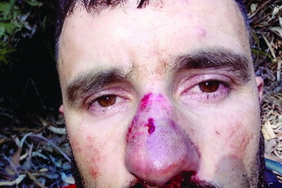 Marcas bem visíveis na face de Pedro Moreira