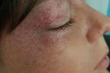 Tyler Broome ficou com a cabeça deformada após brincadeira em roda de parque infantil