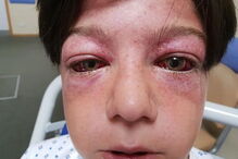 Tyler Broome ficou com a cabeça deformada após brincadeira em roda de parque infantil