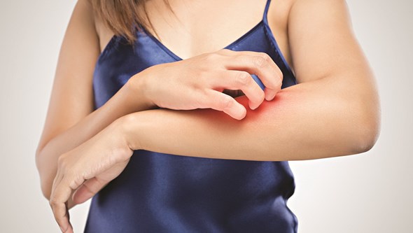 Dermatite atópica provoca erupção cutânea e prejudica a saúde mental do doente