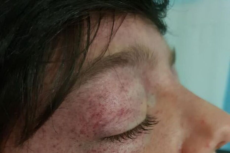 Tyler Broome ficou com a cabeça deformada após brincadeira em roda de parque infantil