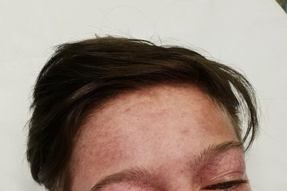 Tyler Broome ficou com a cabeça deformada após brincadeira em roda de parque infantil