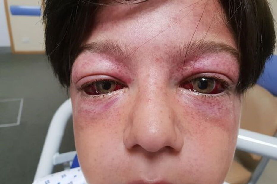 Tyler Broome ficou com a cabeça deformada após brincadeira em roda de parque infantil