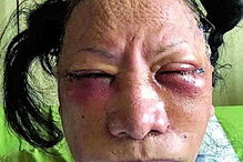 ‘Ataque’ a opositora indonésia afinal era cirurgia plástica