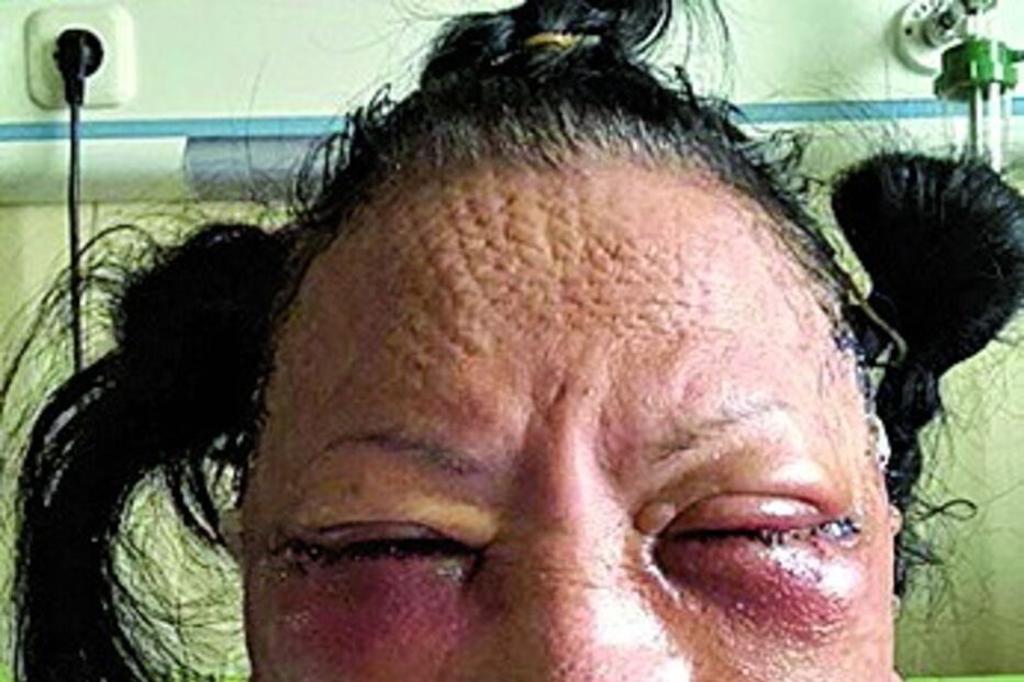 ‘Ataque’ a opositora indonésia afinal era cirurgia plástica