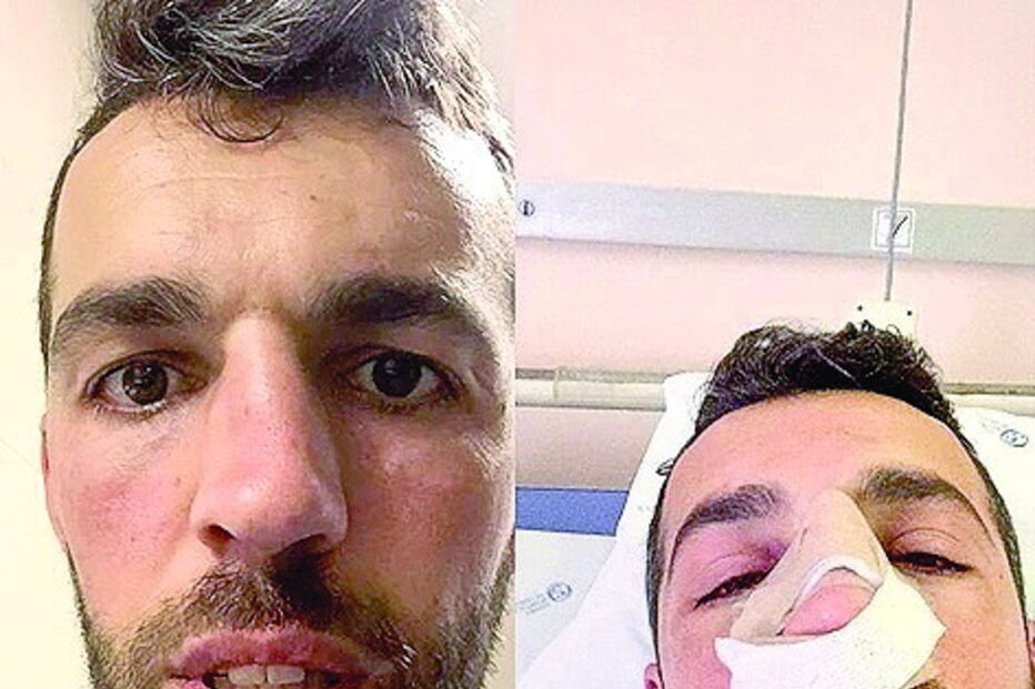 Agente Romeu Silva foi operado ao nariz