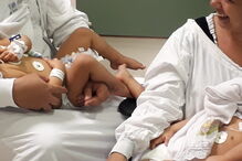 Siamesas unidas pela cabeça separadas no Brasil