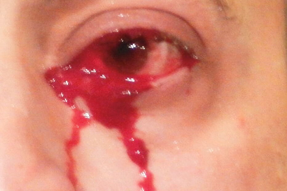 Homem sofre de condição rara que o faz chorar sangue