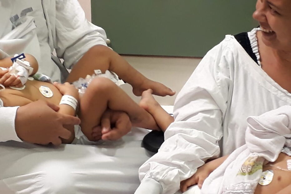 Siamesas unidas pela cabeça separadas no Brasil