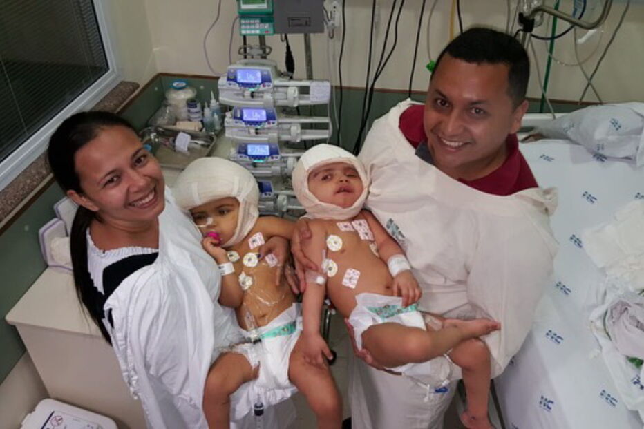 Siamesas unidas pela cabeça separadas no Brasil